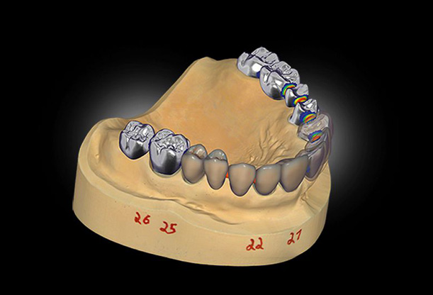 Exocad DentalCad