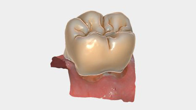 exocad - korony anatomiczne