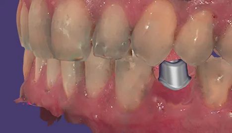 exocad - moduł implantu