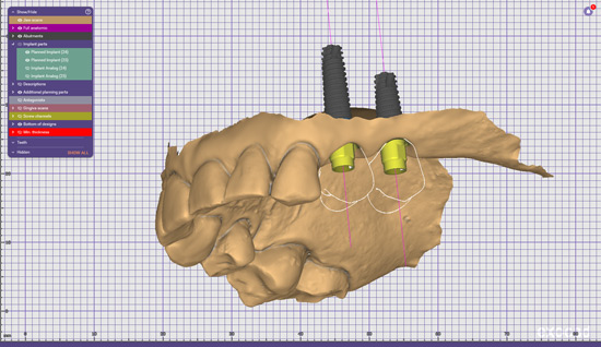 Implanty w systemie CAD/CAM